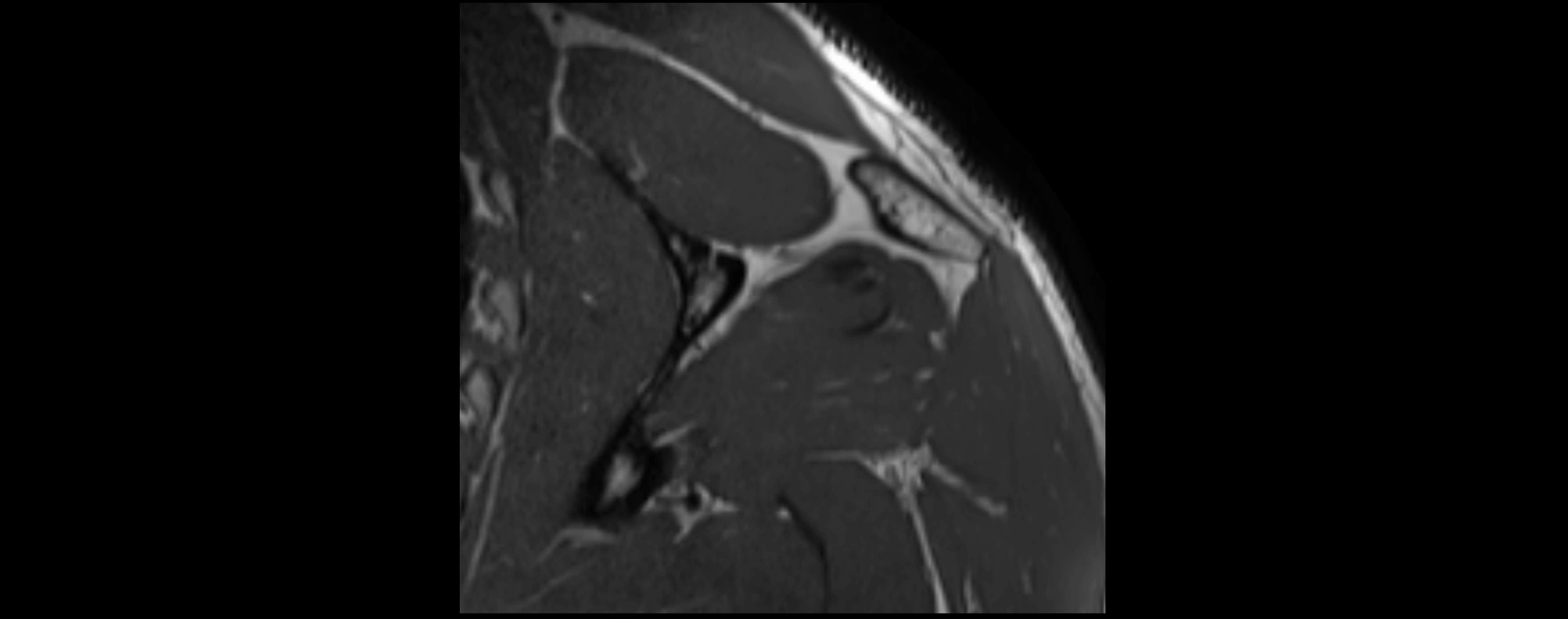 shoulder ligments coronal  cross sectional anatomy 3T MRI AI enhanced radiology image -img-00001-00039.webp